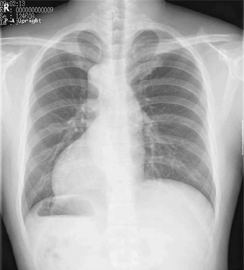 Plain-chest-X-ray-findings-Dextrocardia-was-noted-No.png